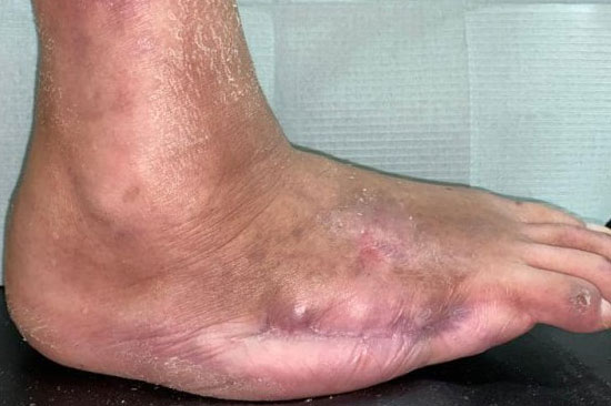 CANADI Clínica de Heridas y Pie Diabético en Hidalgo